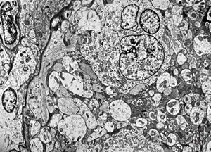 M,13y. | ganglioglioma M,13y. | ganglioglioma